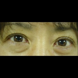 Before-Lower Blepharoplasty