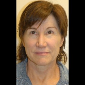 Before-Liquid Facelift