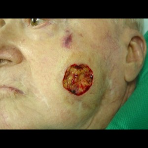 Before-Cheek Reconstruction