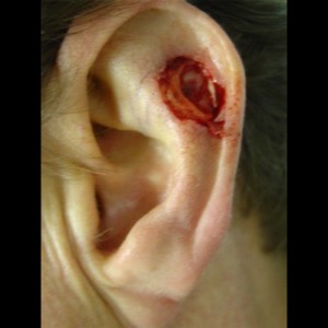 Before-Ear Reconstruction