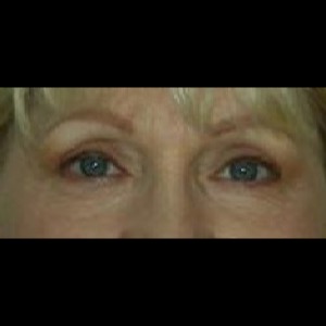 After-Upper & Lower Blepharoplasty