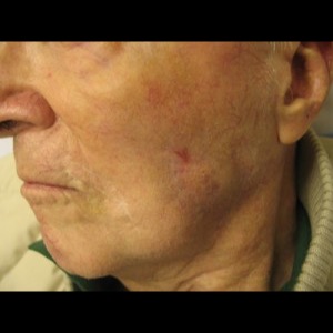 After-Cheek Reconstruction