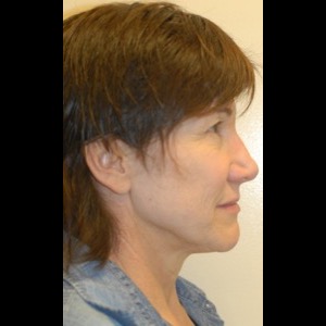 Before-Liquid Facelift