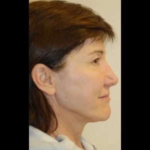 After-Liquid Facelift