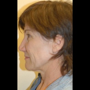 Before-Liquid Facelift