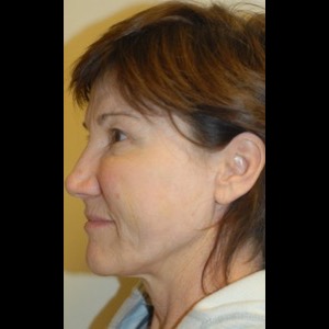 After-Liquid Facelift