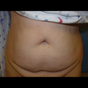 Before-Liposuction