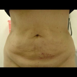 After-Liposuction