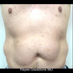 Before-AYON Body Contouring System Powered by Renuvion