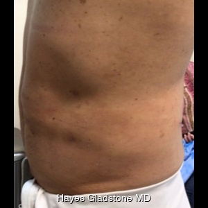 After-AYON Body Contouring System Powered by Renuvion