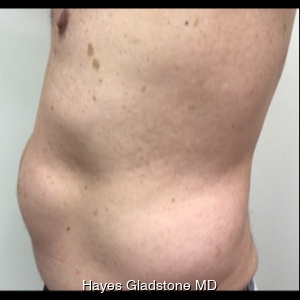 Before-AYON Body Contouring System Powered by Renuvion