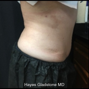 After-AYON Body Contouring System Powered by Renuvion