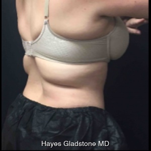 Before-AYON Body Contouring System Powered by Renuvion