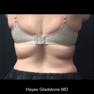 Before-AYON Body Contouring System Powered by Renuvion