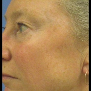 After-Laser Skin Resurfacing