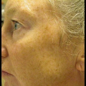 Before-Laser Skin Resurfacing