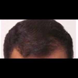 After-Hair Restoration
