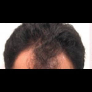 Before-Hair Restoration