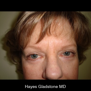 After-Upper and Lower + Laser Resurface