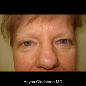 Before-Upper and Lower + Laser Resurface