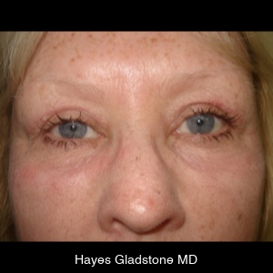 After-Upper and Lower + Laser Resurface