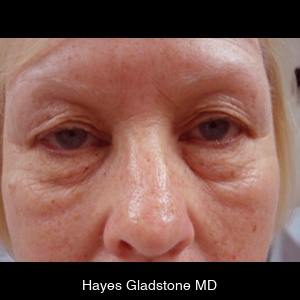 Before-Upper and Lower + Laser Resurface