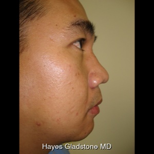 Before-Non Surgical Rhynoplasty and Chin Augmentation