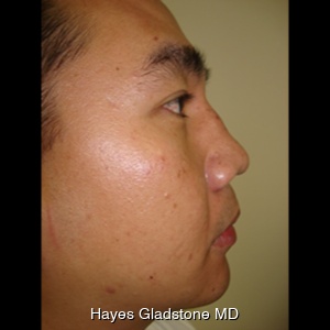 After-Non Surgical Rhynoplasty and Chin Augmentation