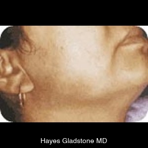 After-Laser Hair Removal