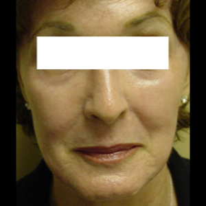 After-Laser Skin Resurfacing