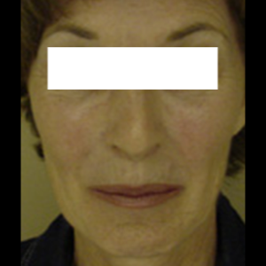 Before-Laser Skin Resurfacing