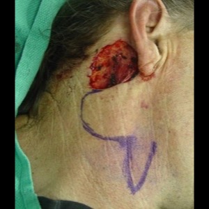 Before-Neck Reconstruction