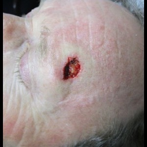 Before-Forehead Reconstruction