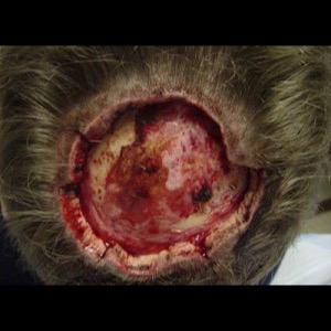 Before-Scalp Reconstruction