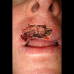 Before-Lip Reconstruction
