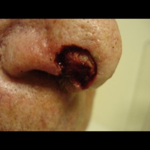 Before-Nose Reconstruction