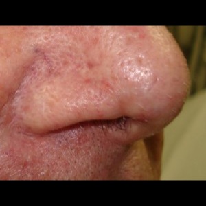 After-Nose Reconstruction