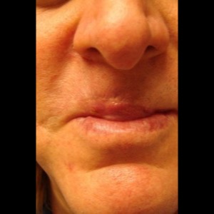 After-Lip Reconstruction