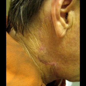 After-Neck Reconstruction