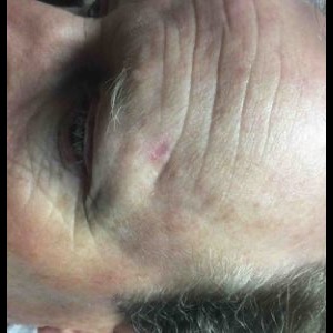 After-Forehead Reconstruction