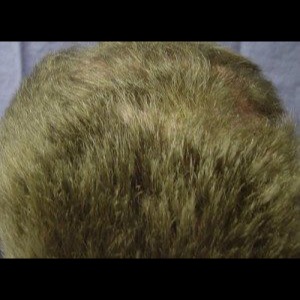 After-Scalp Reconstruction