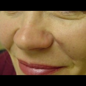 After-Nose Reconstruction