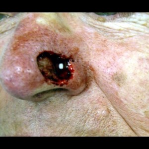 Before-Nose Reconstruction