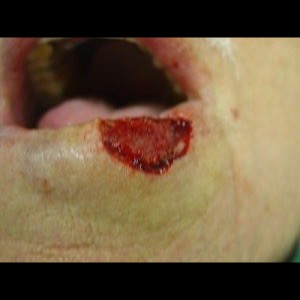 Before-Lip Reconstruction