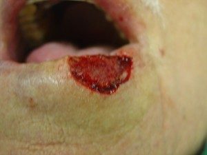 Before-Lip Reconstruction