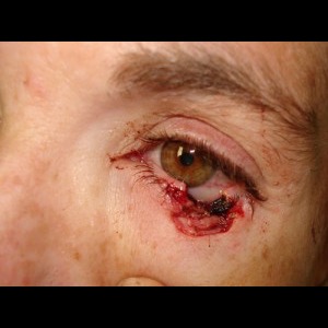 Before-Eyelid Reconstruction