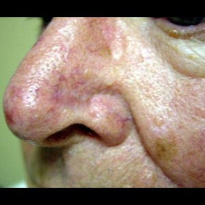 After-Nose Reconstruction
