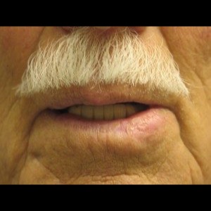 After-Lip Reconstruction