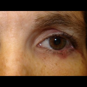 After-Eyelid Reconstruction