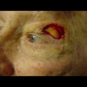 Before-Eyelid Reconstruction